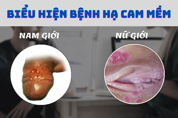 Biểu hiện của bệnh hạ cam mềm