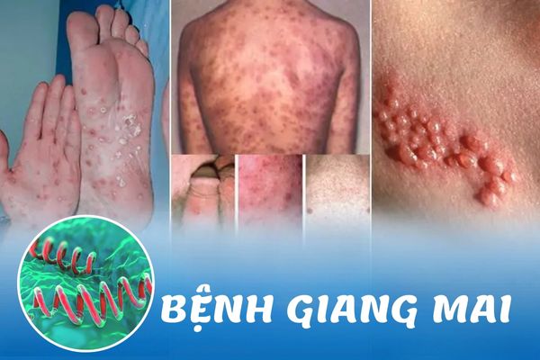 Bệnh giang mai là bệnh xã hội nguy hiểm nhất hiện nay