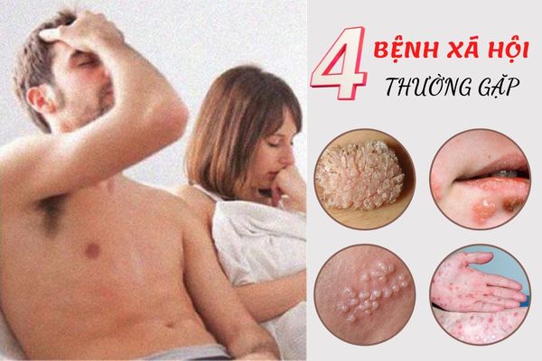 Top 4 bệnh xã hội thường gặp nhất – Cách điều trị hiệu quả