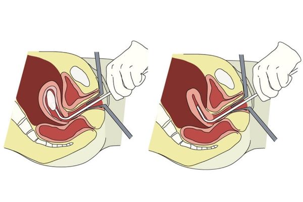 Tại sao nổi mụn nhọt ở vùng kín – Cách điều trị hiệu quả