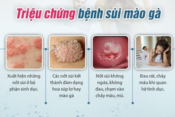 Sùi mào gà có nhiều dấu hiệu nhận biết khác nhau