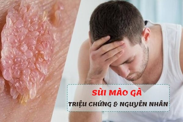 Dấu hiệu nhận biết và nguyên nhân gây bệnh sùi mào gà