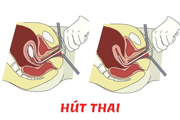 Bao quy đầu nổi hột cảnh báo bệnh gì? Cách điều trị hiệu quả