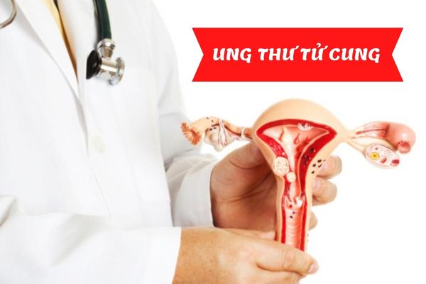 Ung thư tử cung: Nguyên nhân, dấu hiệu và cách điều trị hợp lý