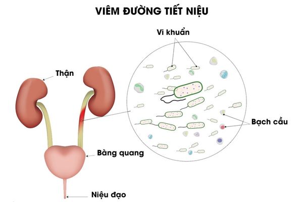 Địa chỉ chữa viêm đường tiết niệu uy tín