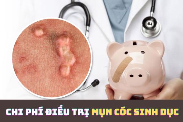 Chi phí điều trị mụn cóc sinh dục bao nhiêu tiền?