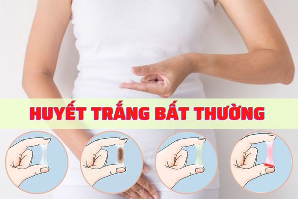 Nhận biết nhanh huyết trắng bất thường – Cách điều trị hiệu quả