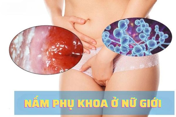 Tìm hiểu nấm phụ khoa đáng lo ngại như thế nào?