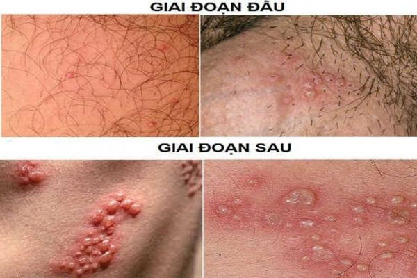 Dấu hiệu nhận biết mụn rộp sinh dục ở nam giới