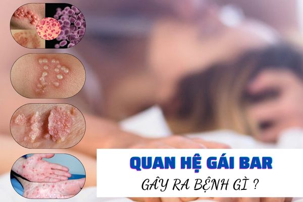 Quan hệ gái Bar – Nguy cơ cao lây nhiễm các bệnh xã hội nguy hiểm