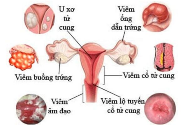 Các bệnh lý phụ khoa ảnh hưởng đến chất lượng quan hệ của các chị em