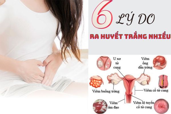 Top 6 lý do gây ra huyết trắng nhiều mà chị em cần biết