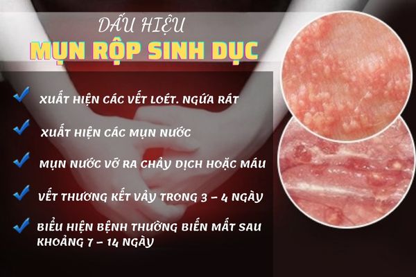 Nên xét nghiệm mụn rộp sinh dục nếu có các triệu chứng bất thường