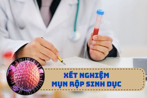 Xét nghiệm mụn rộp sinh dục ở đâu uy tín?