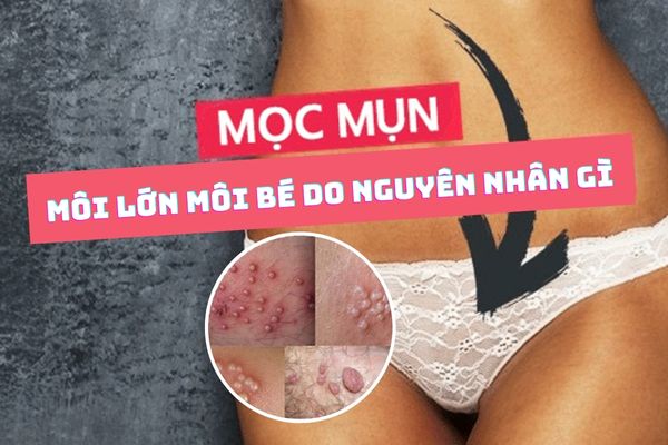 Mọc mụn môi lớn môi bé – Cảnh báo bệnh xã hội nguy hiểm