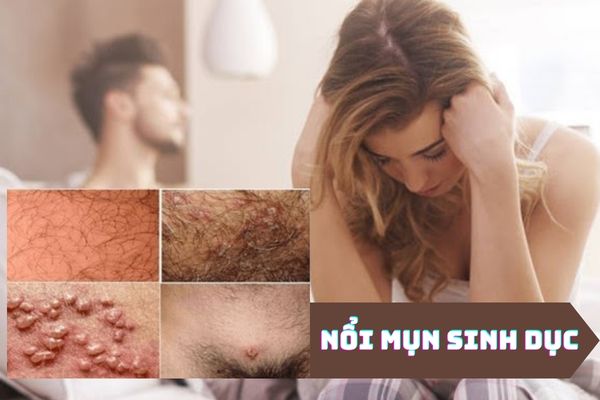 Nổi mụn sinh dục ở nam và nữ cảnh báo bệnh gì?