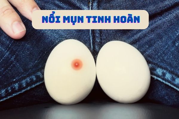 Nổi mụn tinh hoàn bị bệnh gì? Cách điều trị hiệu quả