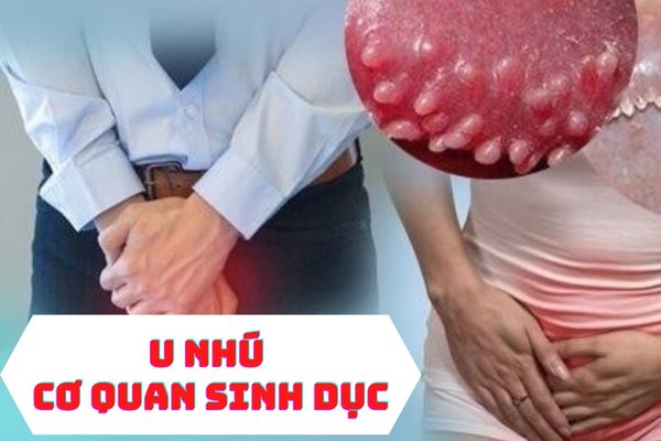 U nhú cơ quan sinh dục là gì – Cách điều trị hiệu quả