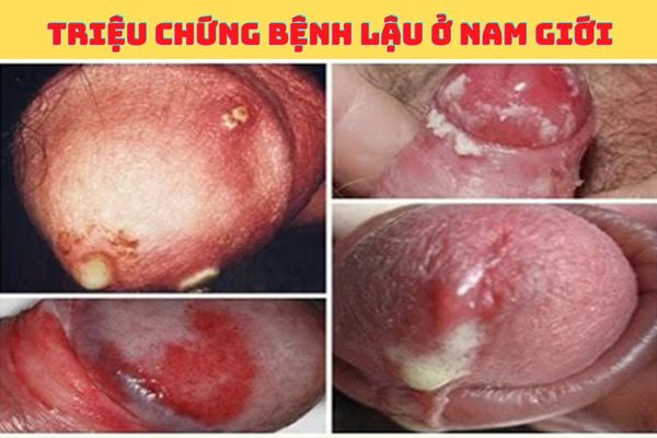 Dấu hiệu nhận biết bệnh lậu ở nam giới