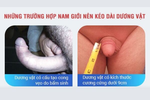 Những trường hợp cần phải thực hiện kéo dài kích thước dương vật