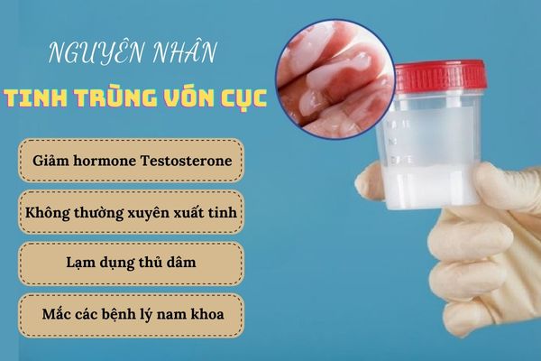 Nguyên nhân dẫn đến tình trạng tinh trùng vón cục ở nam giới