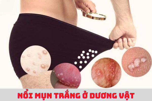 Nổi mụn trắng ở dương vật nguyên nhân do đâu?