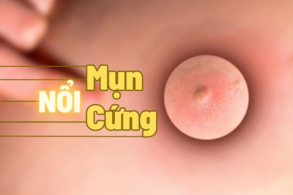 Lưu ý hiện tượng nổi mụn cứng bất thường