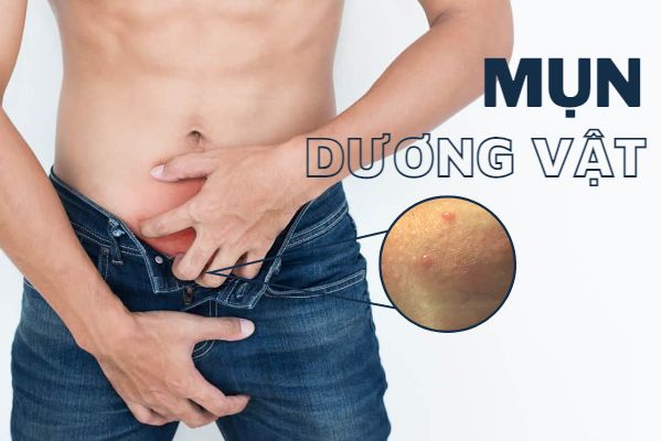 Mụn dương vật cảnh báo điều gì?