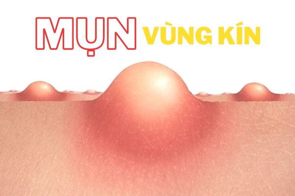 Mụn vùng kín là bị gì và khắc phục ra sao?