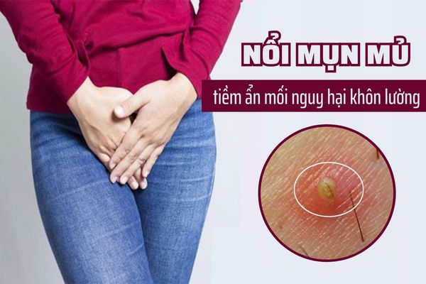 Nổi mụn mủ vùng kín: Nguyên nhân, triệu chứng và cách điều trị