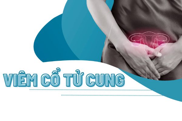 Sự thật về viêm cổ tử cung cần lưu ý