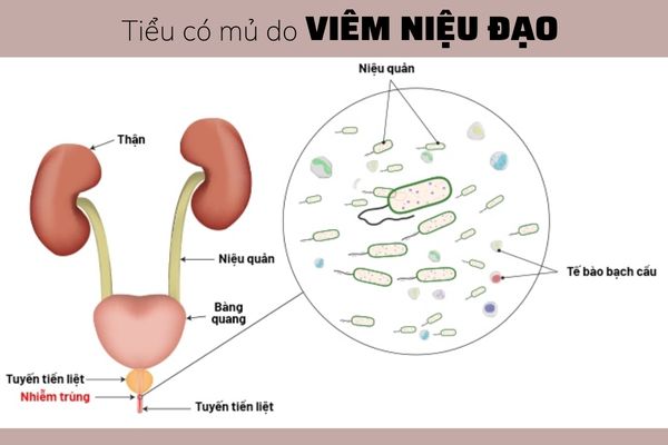 Tieu-co-mu-va-cach-dieu-tri-hieu-qua (3)