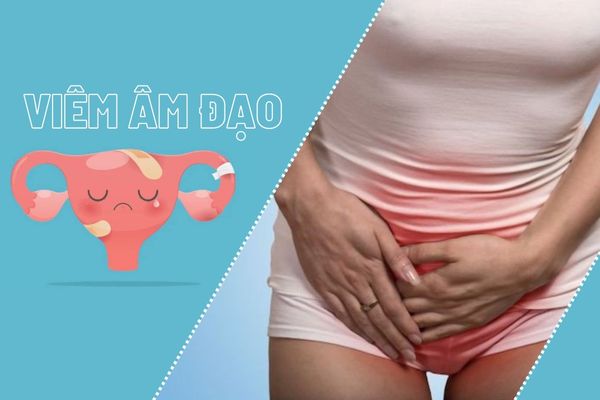 Tổng hợp những sự thật về viêm âm đạo