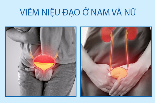 Những điều cần biết về viêm niệu đạo ở nam giới