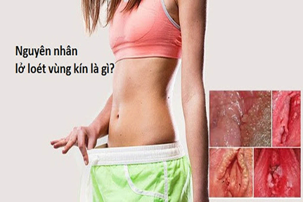 Viêm loét vùng kín ở nữ giới – Dấu hiệu cảnh báo nhiều bệnh lý nguy hiểm