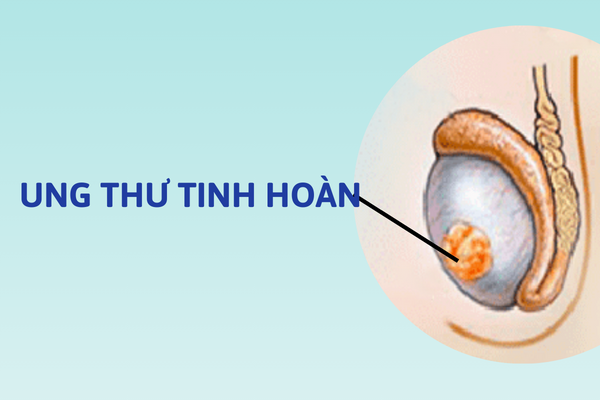 Benh-o-tinh-hoan-su-be-tac-lon-cua-phai-manh-7