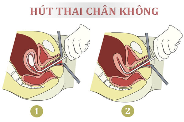 Hut-thai-chan-khong-thuong-duoc-chi-dinh-cho-thai-tu-2-den5-thang-tuoi