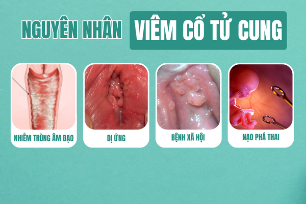 Viem-co-tu-cung-va-nhung-thong-tin-can-biet-3