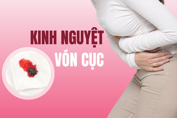 Kinh nguyệt vón cục là do mắc bệnh gì?