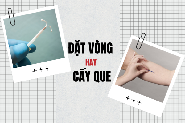 Nên đặt vòng hay cấy que?