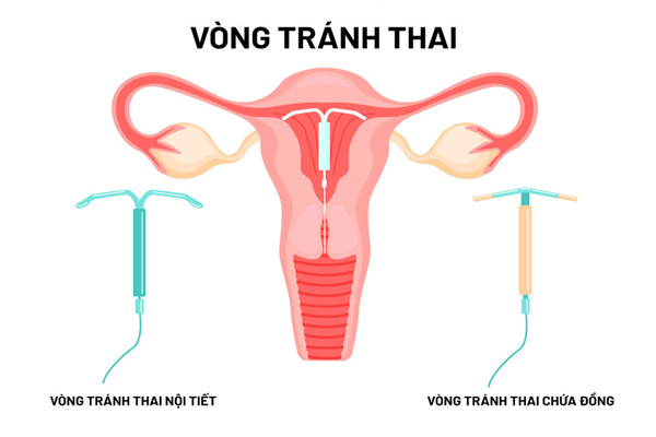 Hai loại vòng tránh thai được chọn đặt phổ biến