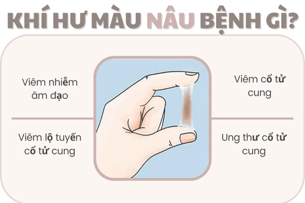 Tìm hiểu khí hư màu nâu bệnh gì?