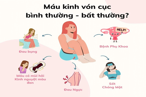 Kinh nguyệt vón cục - Bình thường hay bất thường