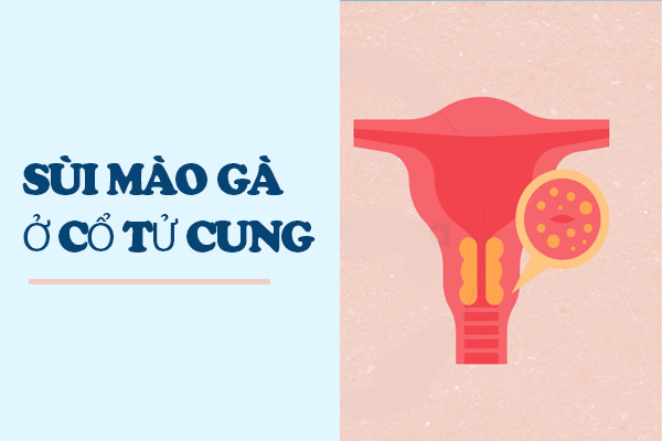 Hình ảnh cụ thể về bệnh sùi mào gà ở cổ tử cung