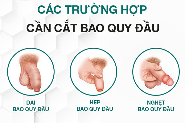 Trường hợp nam giới nên thực hiện cắt bao quy đầu