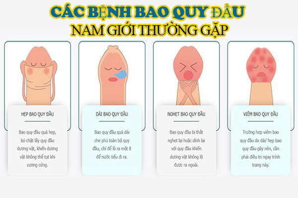 Các bệnh bao quy đầu ở nam giới thường gặp