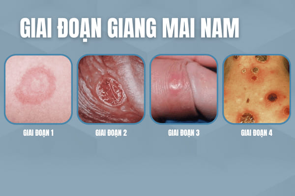 Giai-doan-cua-benh-giang-mai