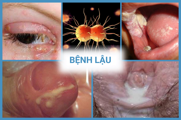 Dieu-tri-benh-lau-hieu-qua-tai-phong-kham-da-khoa-truong-hai-5