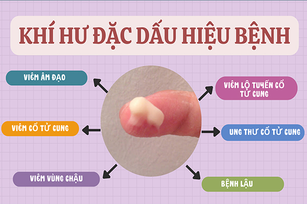 Khí hư đặc dấu hiệu cảnh báo bệnh lý phụ khoa