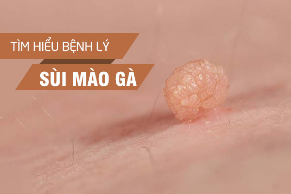 Sùi mào gà và những thông tin cần biết về bệnh